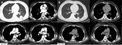 Neoadjuvant Savolitinib targeted therapy stage IIIA-N2 primary lung adenocarcinoma harboring MET Exon 14 skipping mutation: A case report